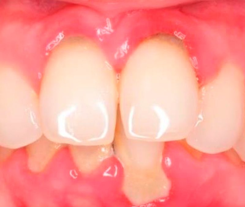 Cómo identificar los síntomas de la periodontitis a tiempo