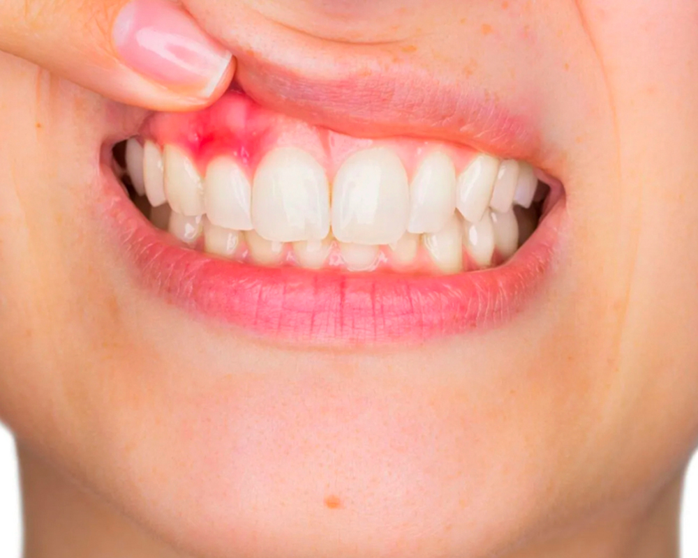 CRYSTALDENT-Periodoncia-01